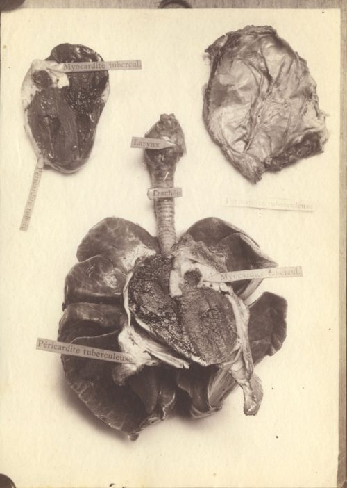 Unbekannt (Künstler*in), Anatomische Studien (Tuberkulöse Myokarditis, tuberkulöse Perikarditis, Graben), ca. 1900