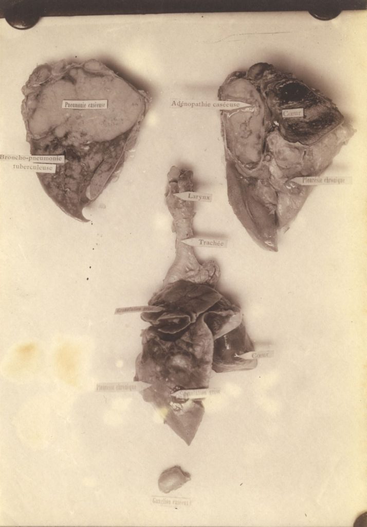 Anatomische Studien (Caseous Lungenentzündung, Herz, Kehlkopf, Caseous Ganglion)