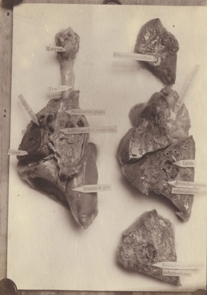 Anatomische Studien (Kehlkopf, Bronchopneumonie, Höhle, tuberkulöse Bronchopneumonie)